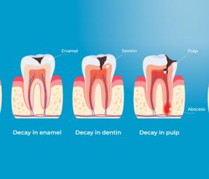 how-to-prevent-cavities-daily-habits-that-work