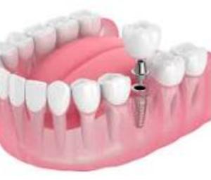 Dental Implants in Your 30s, 40s or 50s: Is There an Ideal Age