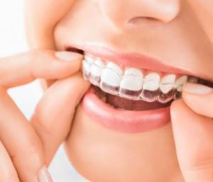 What Nobody Tells You About the First Week With Clear Aligners