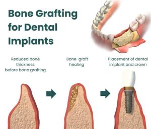 Bone Grafting Before Dental Implants: Why Is It Sometimes Necessary?