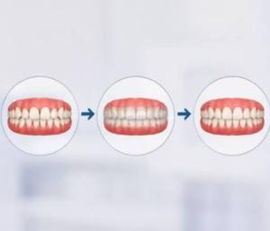 How Do Clear Aligners Straighten Teeth? The Science Explained Simply