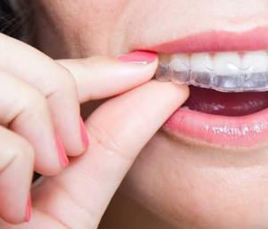Clear Aligners Look Easy—But Are They Really